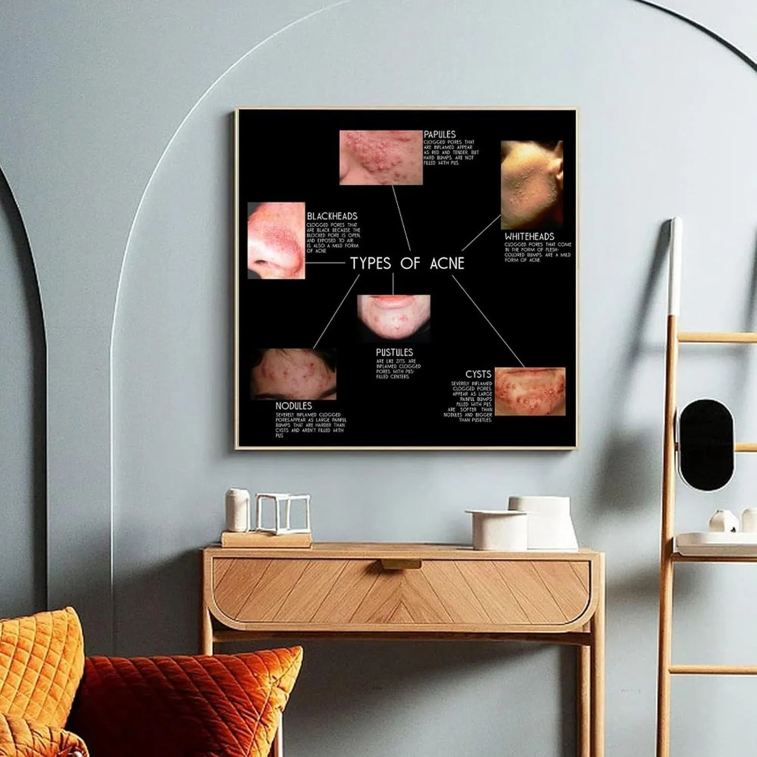 Types of Acne Poster Medical Beauty Poster (1) Wall Poster Art Canvas Printing Living Room Office Bedroom Aesthetic Poster 20x20inch(50x50cm) Frame-style