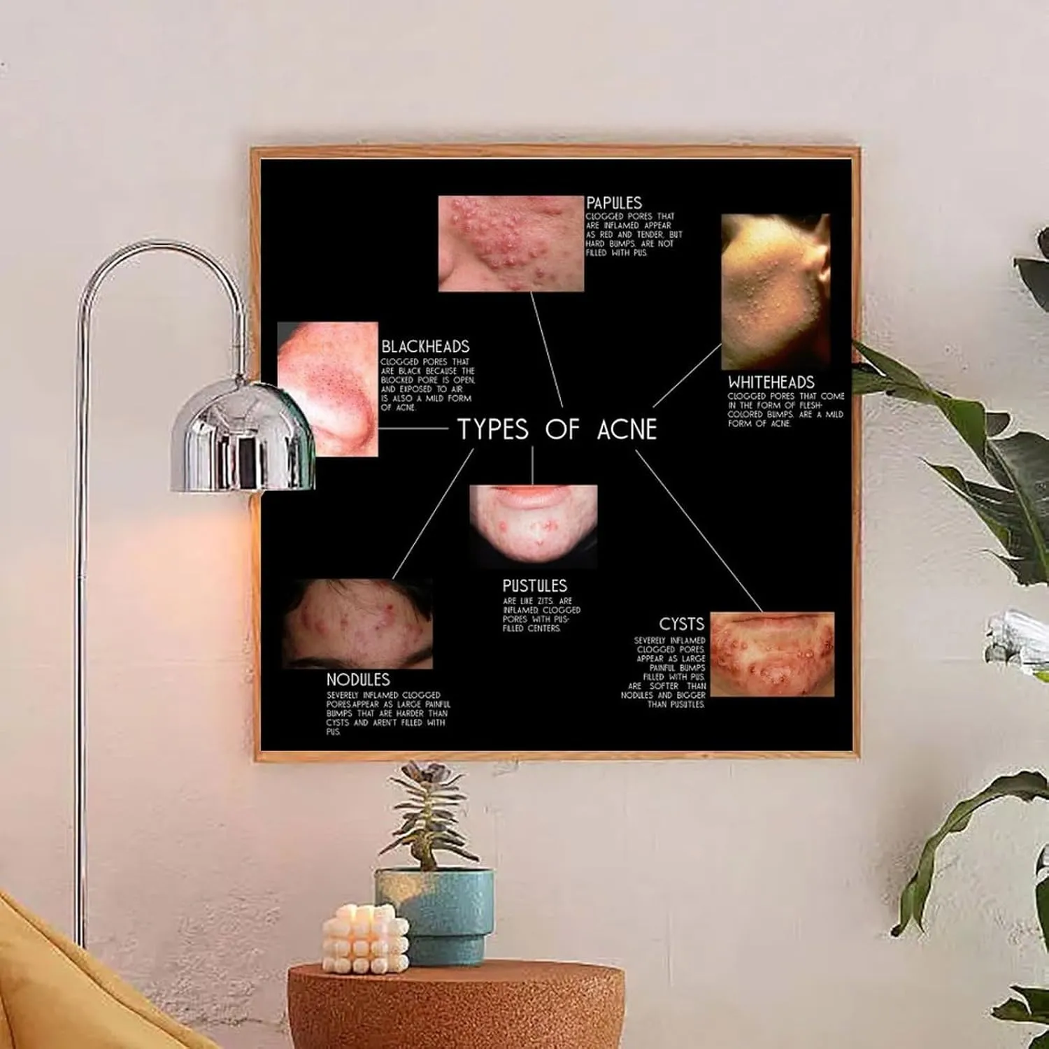 Types of Acne Poster Medical Beauty Poster (1) Wall Poster Art Canvas Printing Living Room Office Bedroom Aesthetic Poster 20x20inch(50x50cm) Frame-style