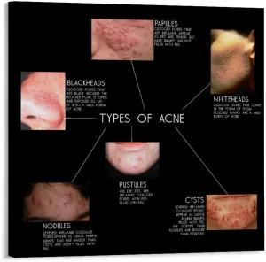 Types of Acne Poster Medical Beauty Poster (1) Wall Poster Art Canvas Printing Living Room Office Bedroom Aesthetic Poster 20x20inch(50x50cm) Frame-style