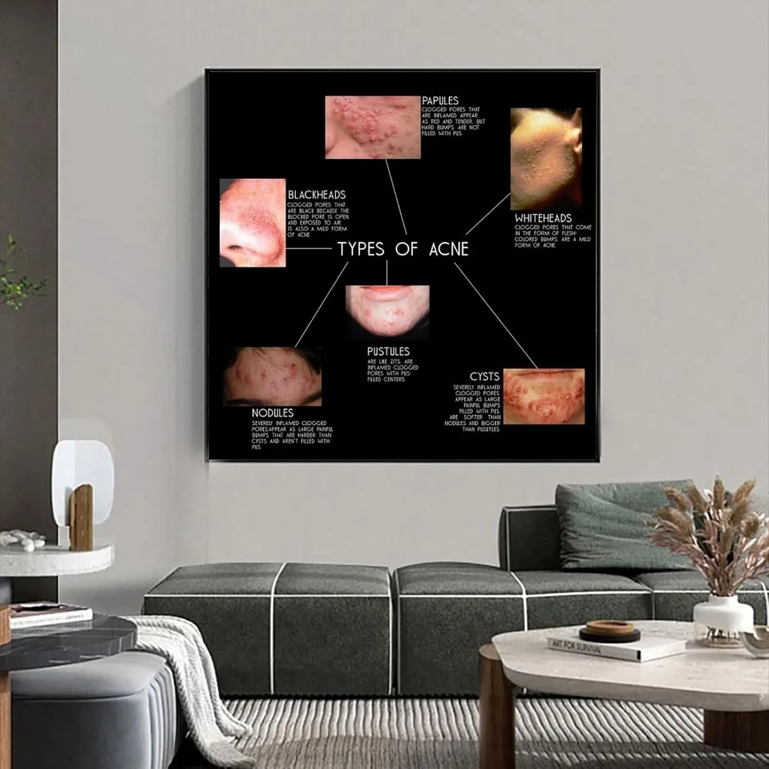 Types of Acne Poster Medical Beauty Poster (1) Wall Poster Art Canvas Printing Living Room Office Bedroom Aesthetic Poster 20x20inch(50x50cm) Frame-style